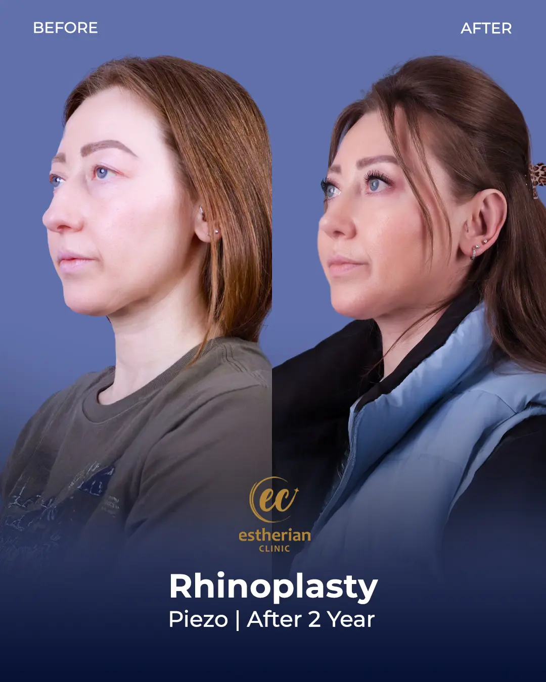 Rhinoplasty Before and After by the Estherian Clinic