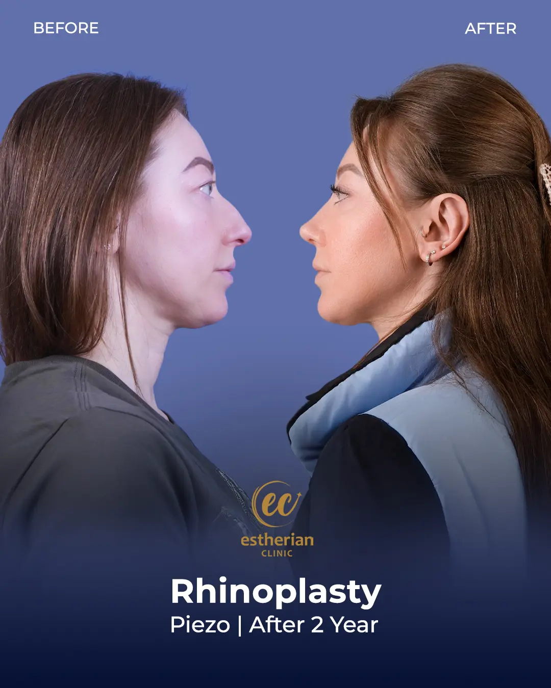 Rhinoplasty Before and After by the Estherian Clinic