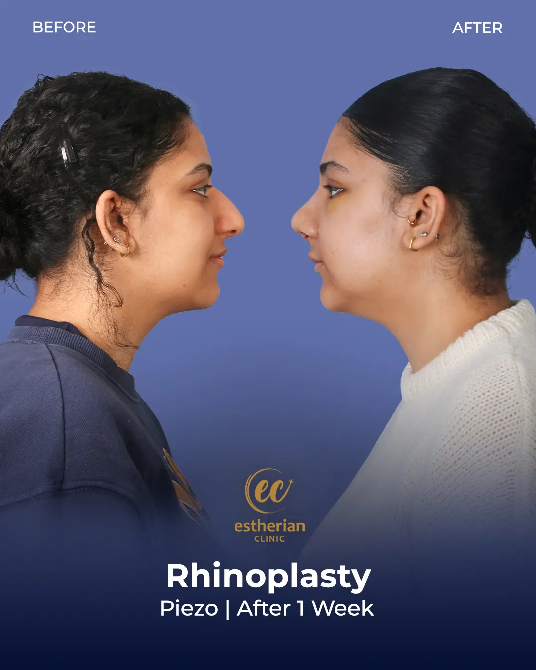 Rhinoplasty Before and After by the Estherian Clinic