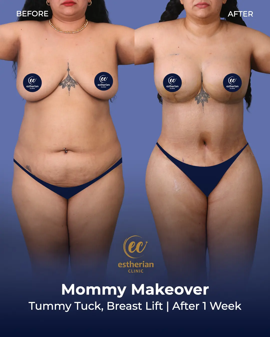 Body Contouring Surgery (before and after) by the Estherian Clinic