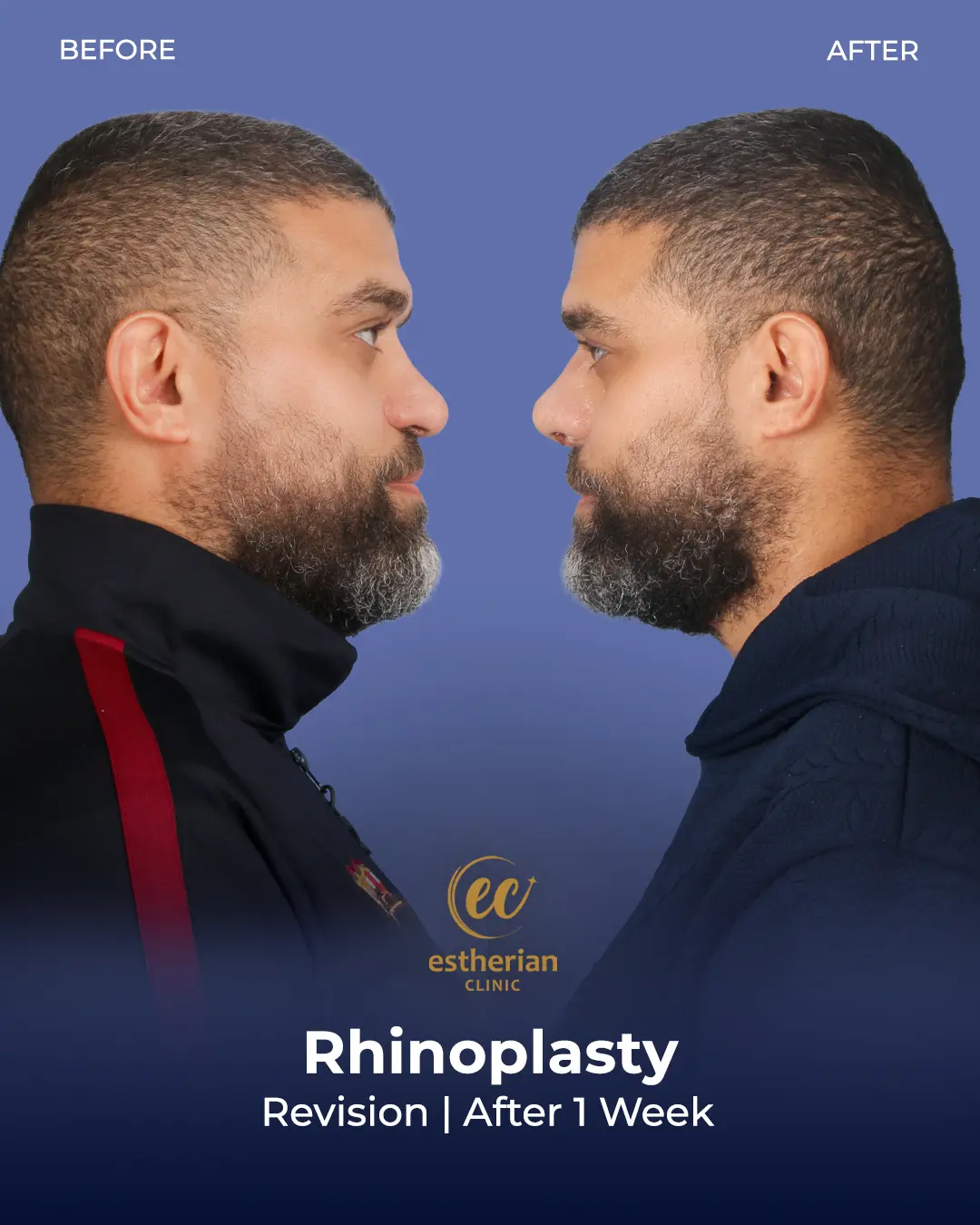 Rhinoplasty Before and After by the Estherian Clinic