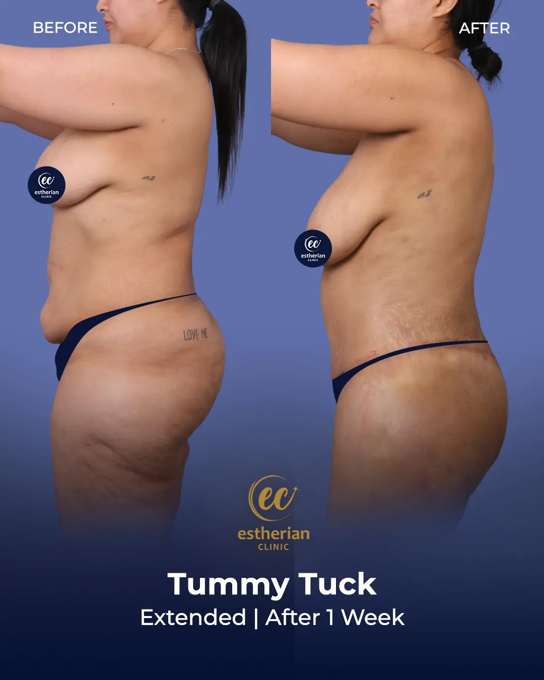 Tummy Tuck Before and after by the Estherian Clinic