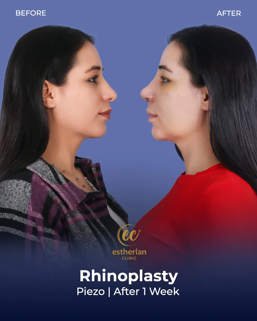 Rhinoplasty Before and After by the Estherian Clinic