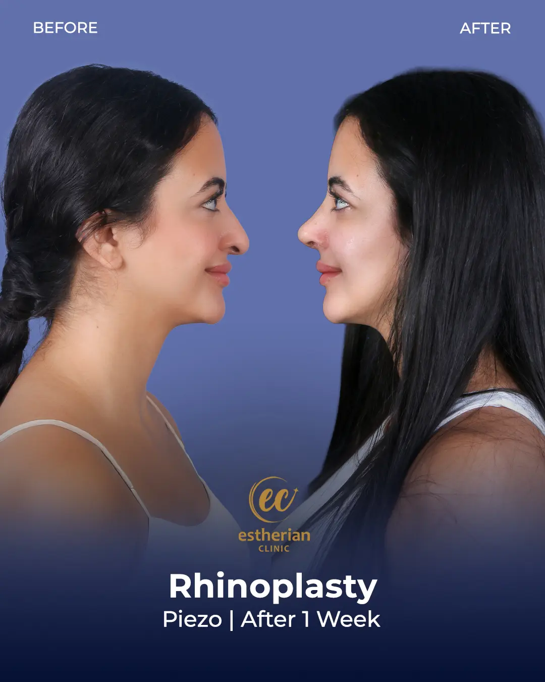 Rhinoplasty Before and After by the Estherian Clinic