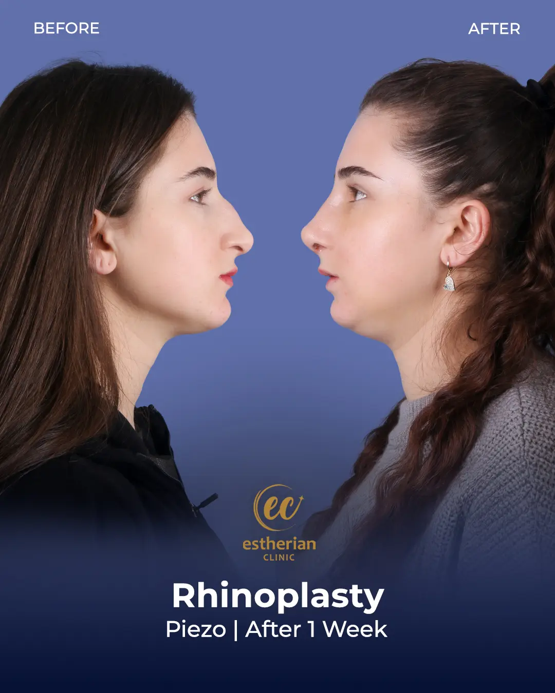 Rhinoplasty Before and After by the Estherian Clinic