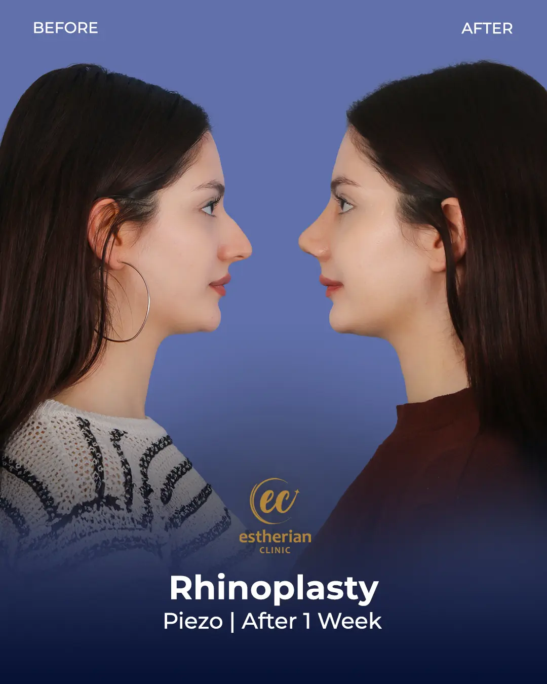 Rhinoplasty Before and After by the Estherian Clinic