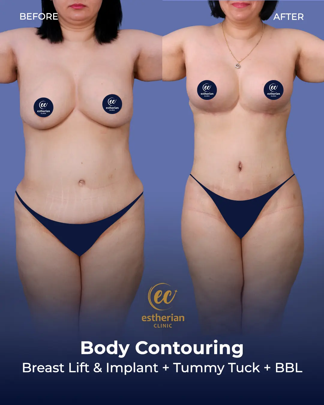 Body Contouring Surgery (before and after) by the Estherian Clinic