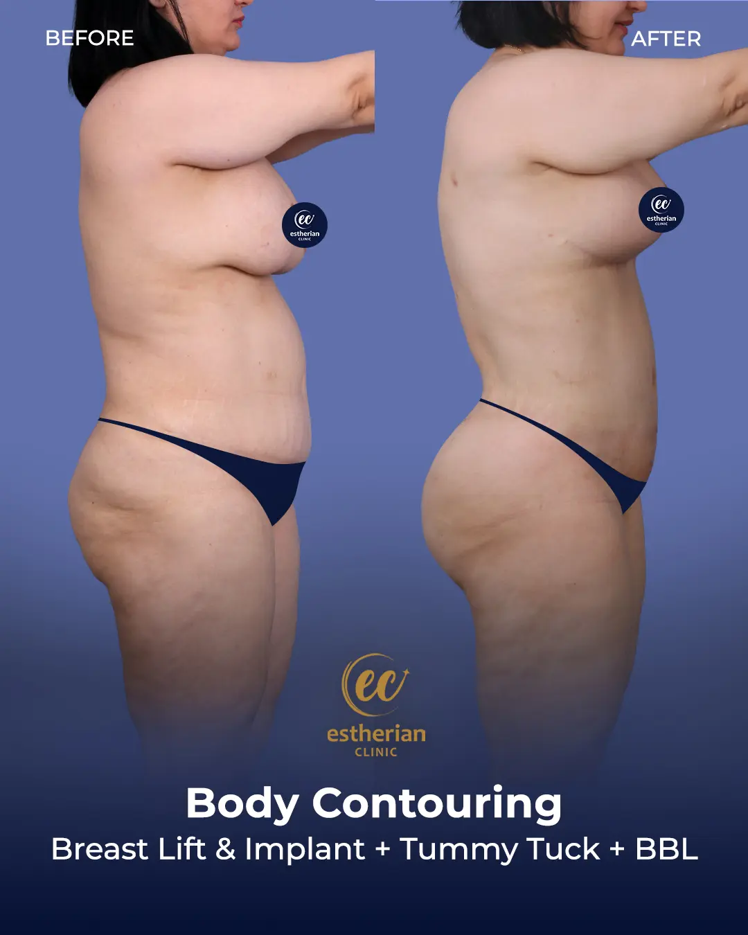 Body Contouring Surgery (before and after) by the Estherian Clinic