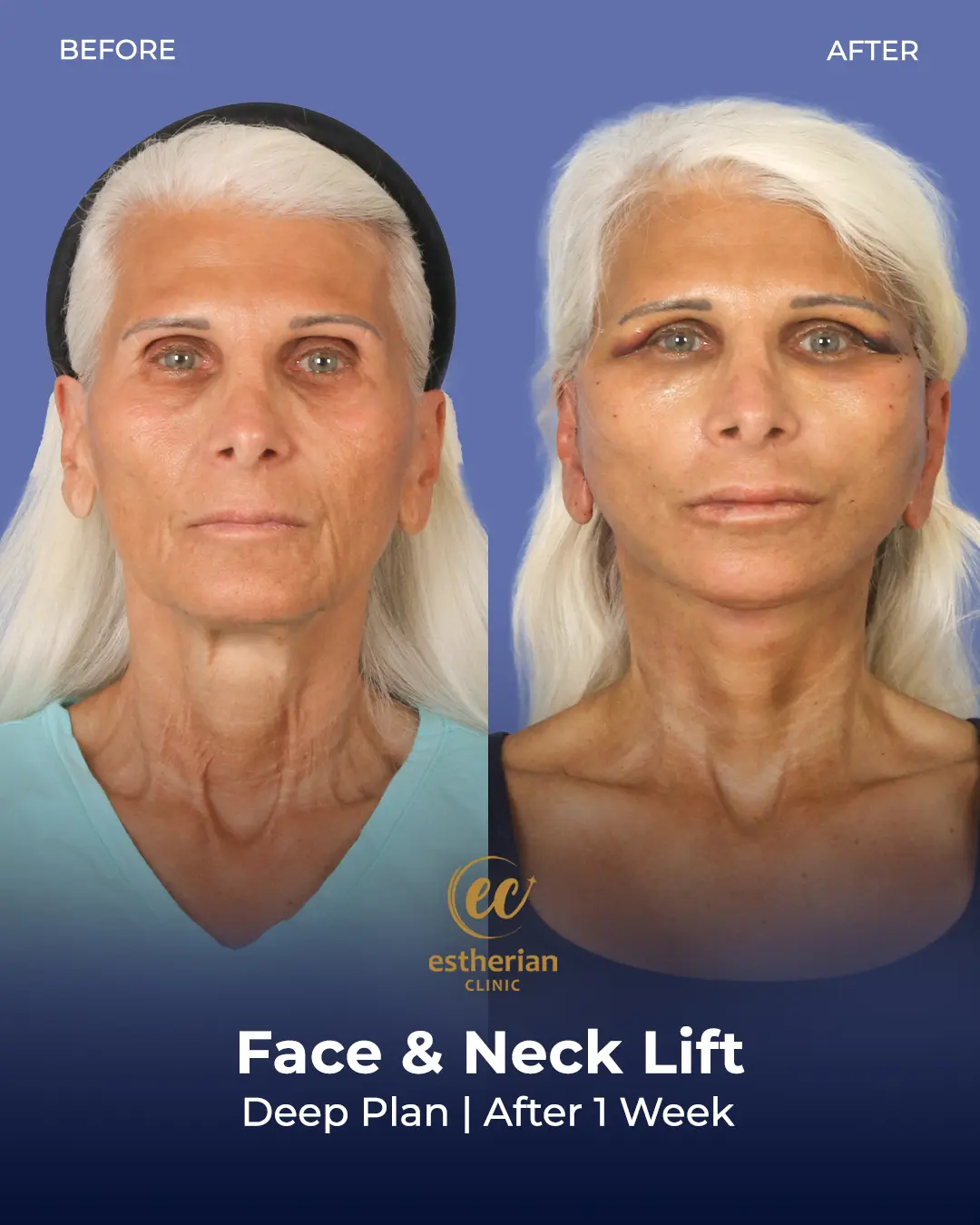 Face and Neck Lift Before and After Gallery by the Estherian Clinic