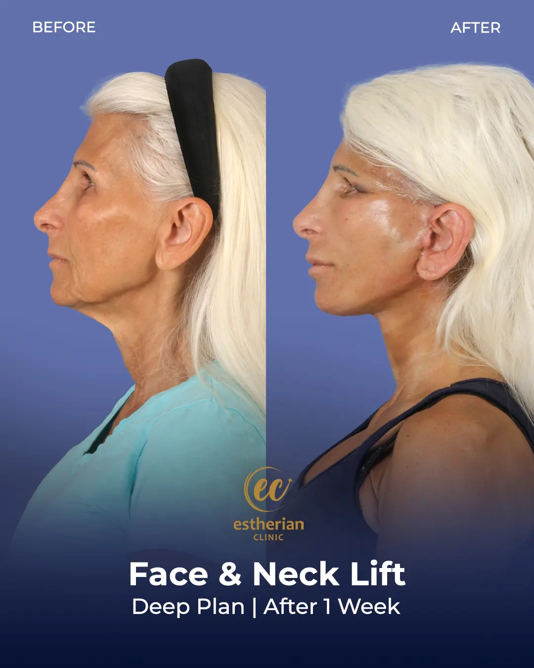 Face and Neck Lift Before and After Gallery by the Estherian Clinic