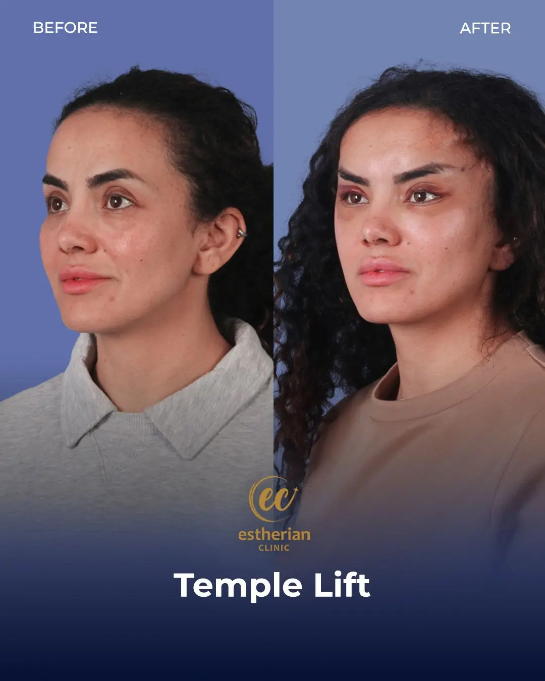 Temporal Lift by the Estherian Clinic