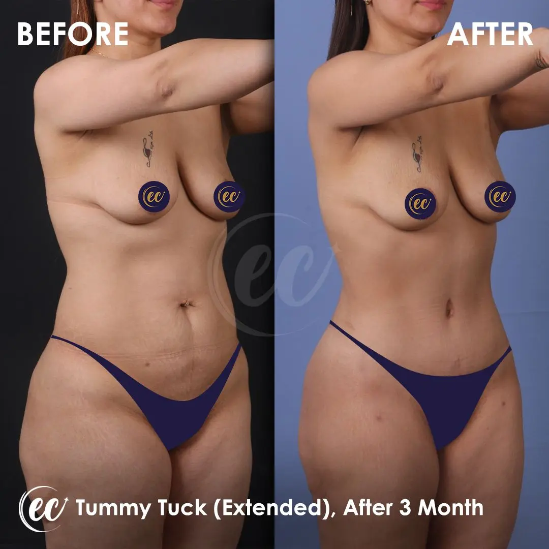 Tummy Tuck Before and after by the Estherian Clinic