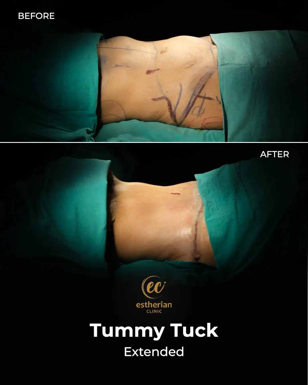 Tummy Tuck Before and after by the Estherian Clinic