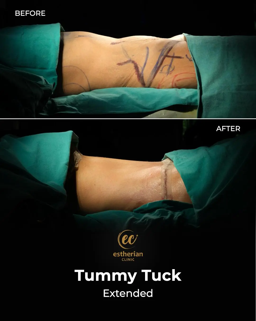 Tummy Tuck Before and after by the Estherian Clinic