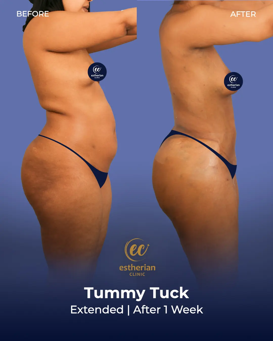 Tummy Tuck Before and after by the Estherian Clinic