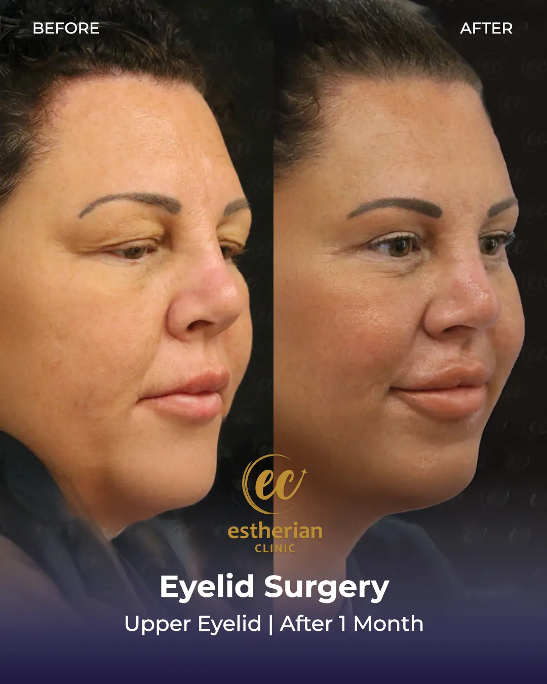 Upper Eyelid Surgery Results by the Estherian Clinic