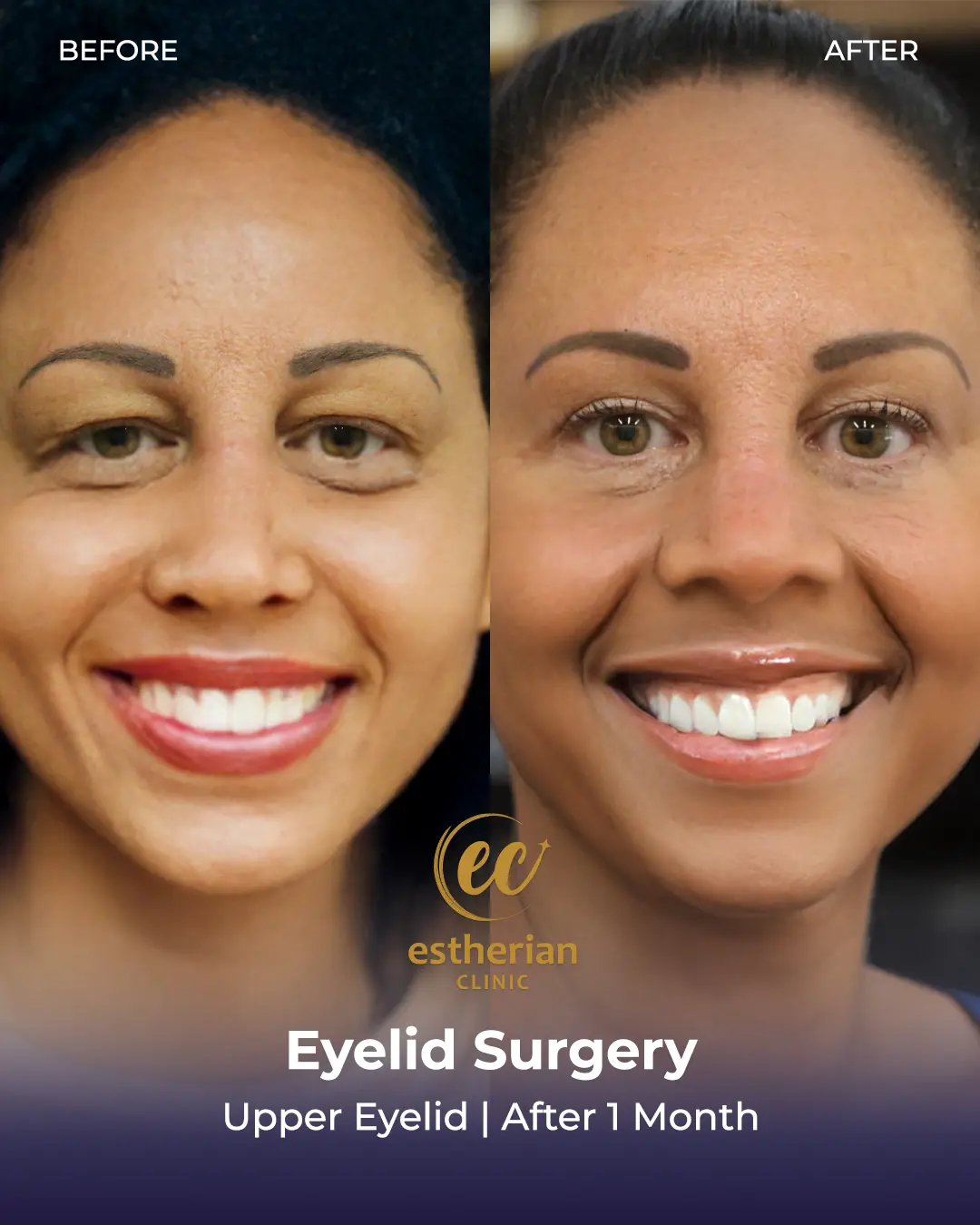 Upper Eyelid Surgery Results by the Estherian Clinic