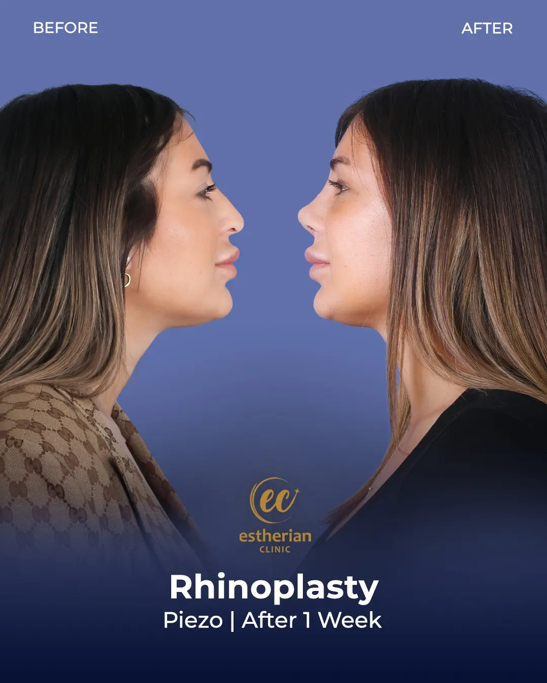 Rhinoplasty Before and After by the Estherian Clinic