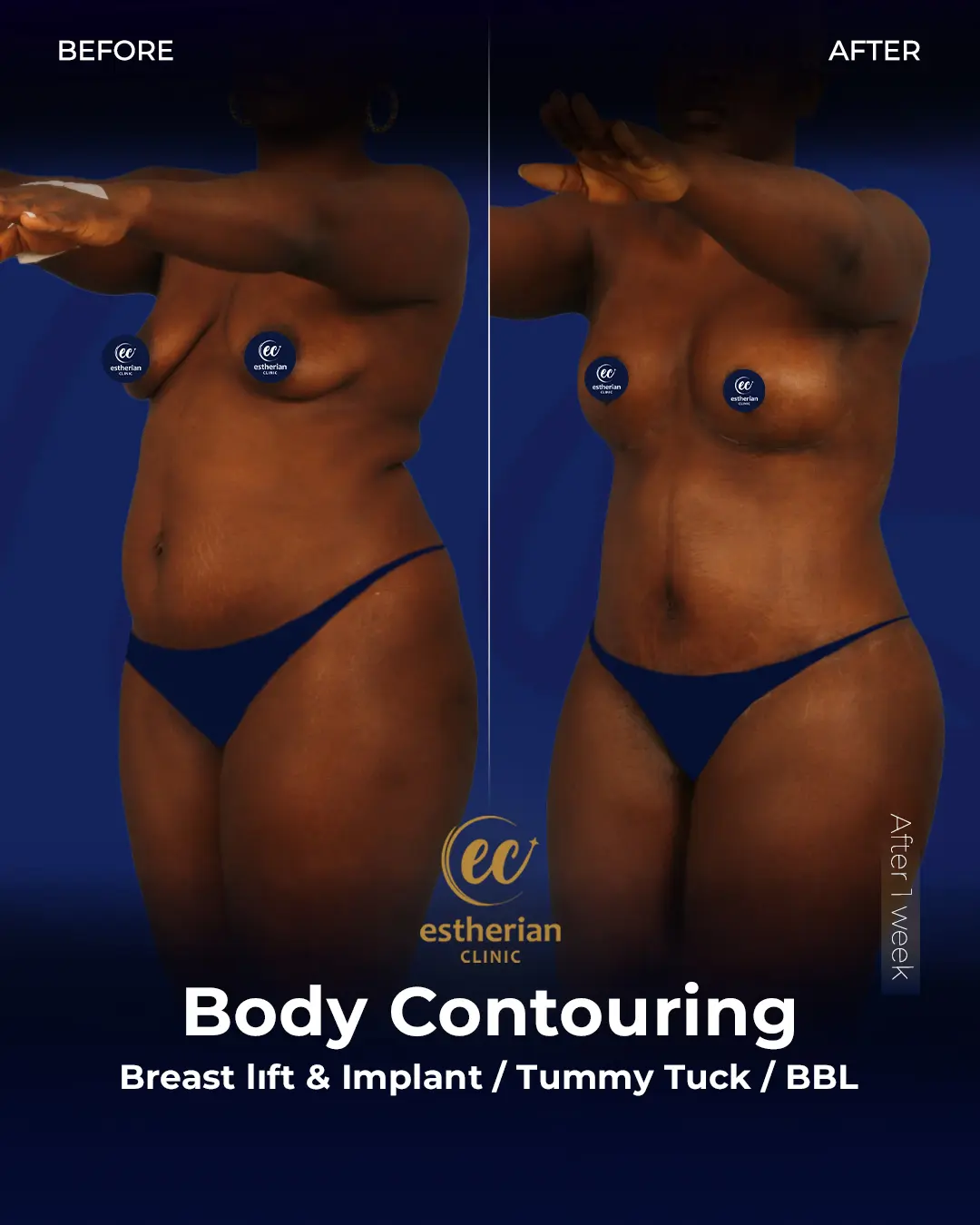Body Contouring Surgery (before and after) by the Estherian Clinic