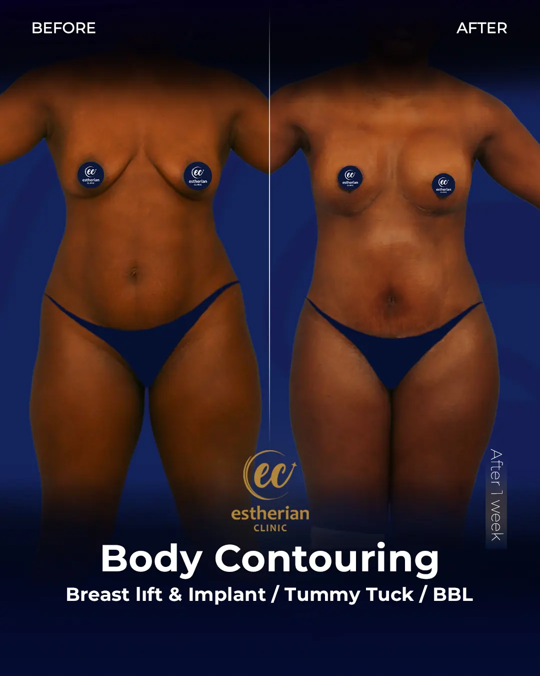Body Contouring Surgery (before and after) by the Estherian Clinic