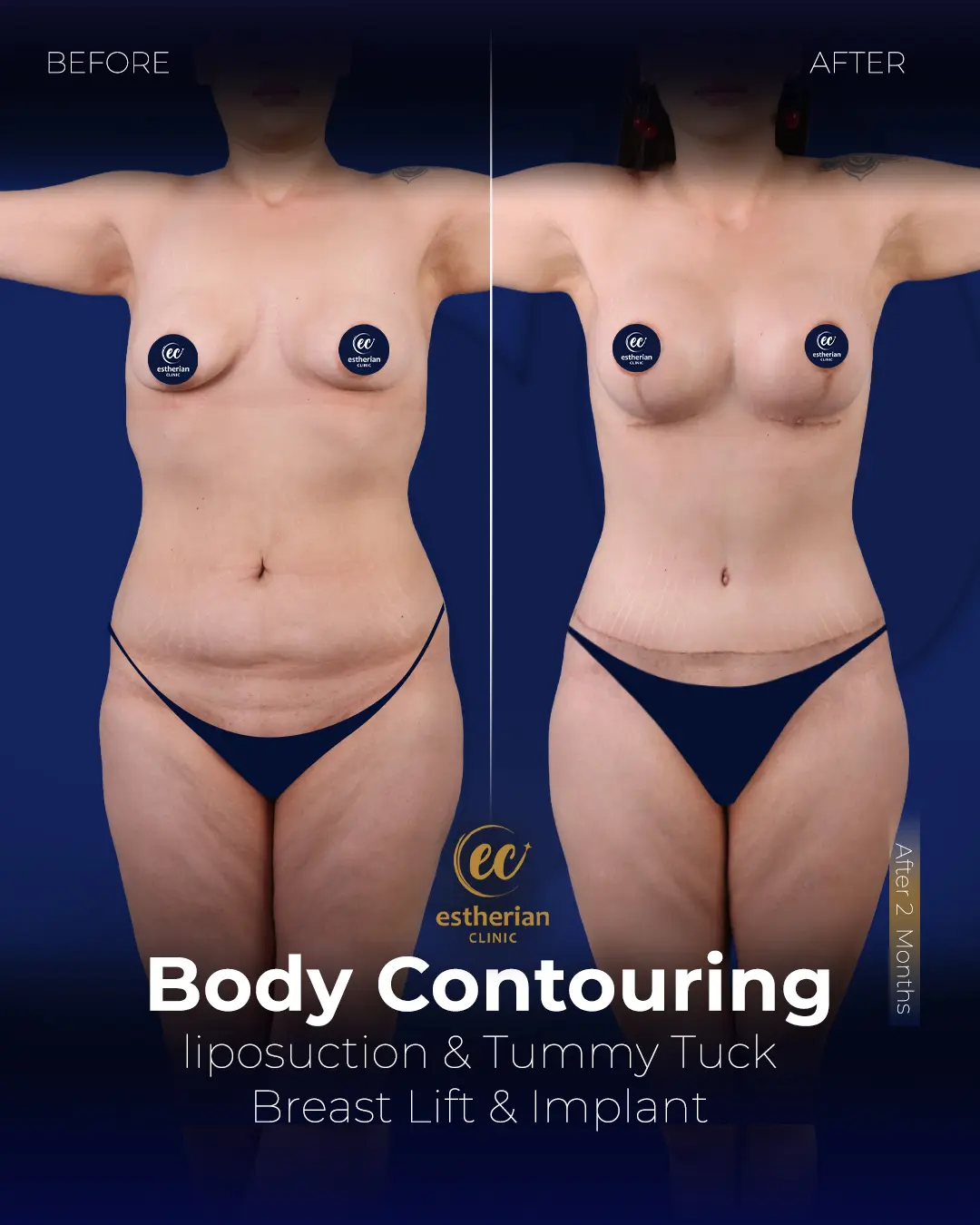 Body Contouring Surgery (before and after) by the Estherian Clinic
