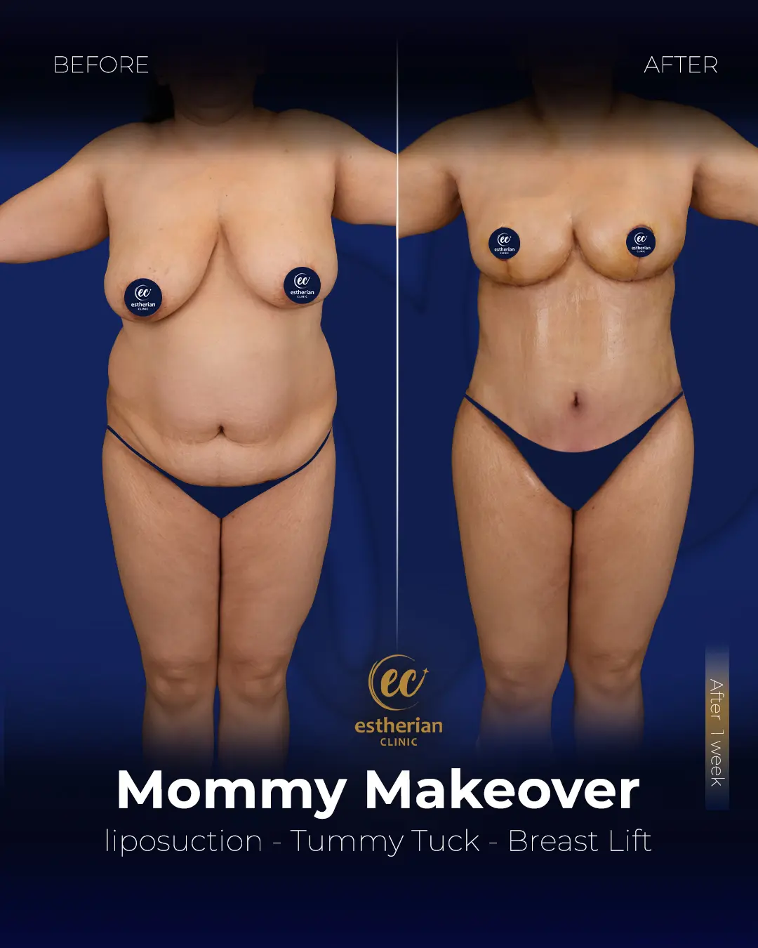 Body Contouring Surgery (before and after) by the Estherian Clinic