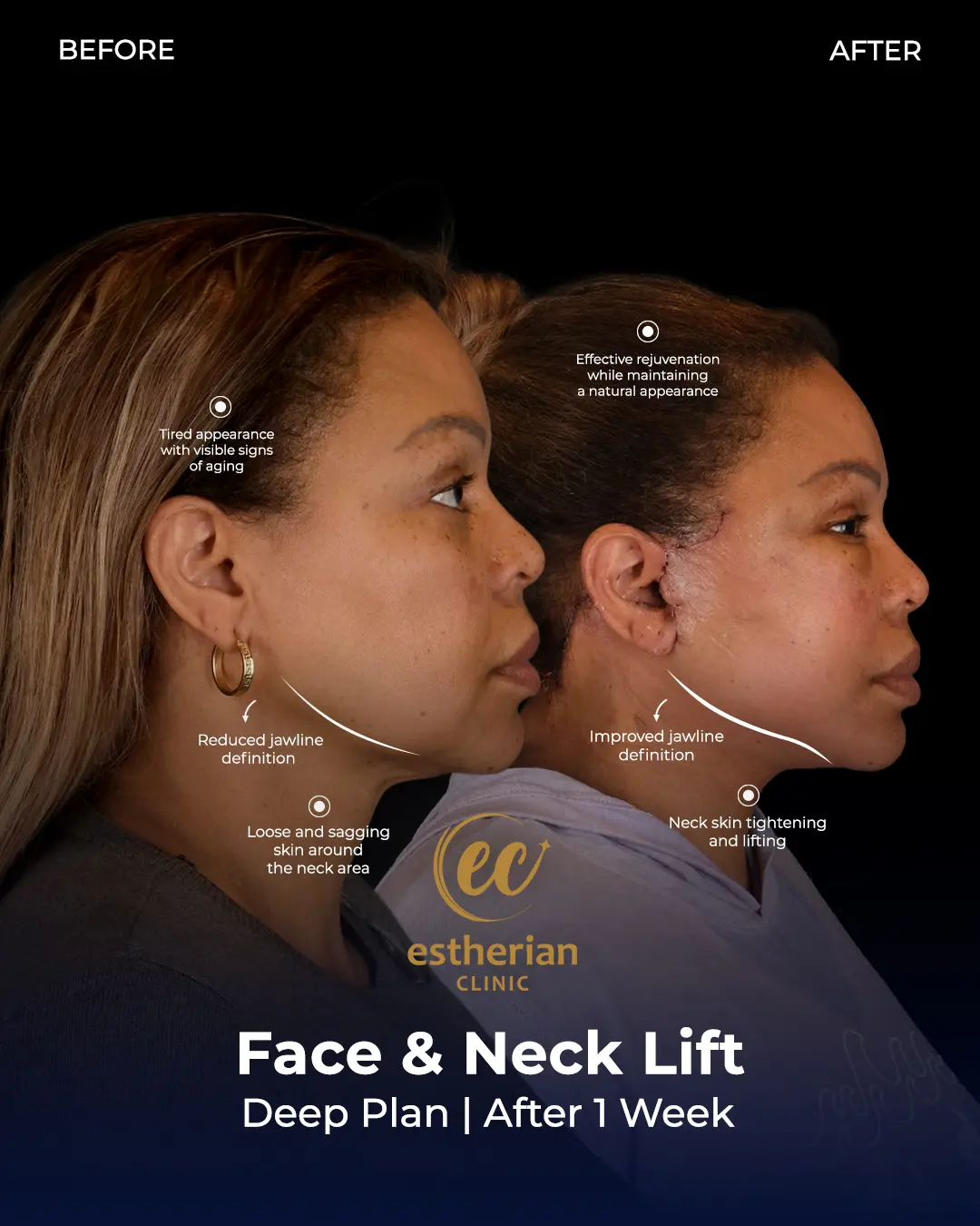 Face and Neck Lift Before and After Gallery by the Estherian Clinic