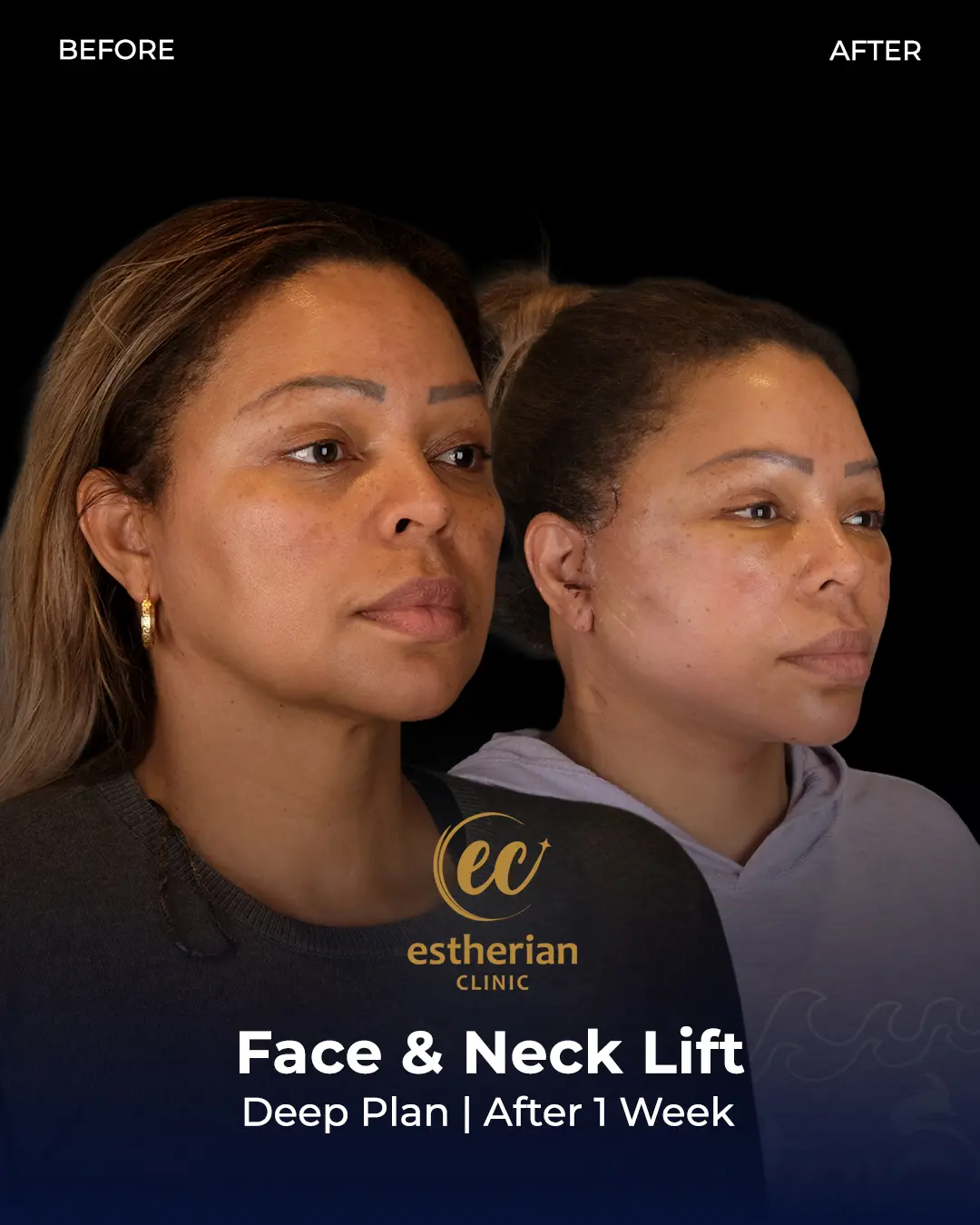 Face and Neck Lift Before and After Gallery by the Estherian Clinic