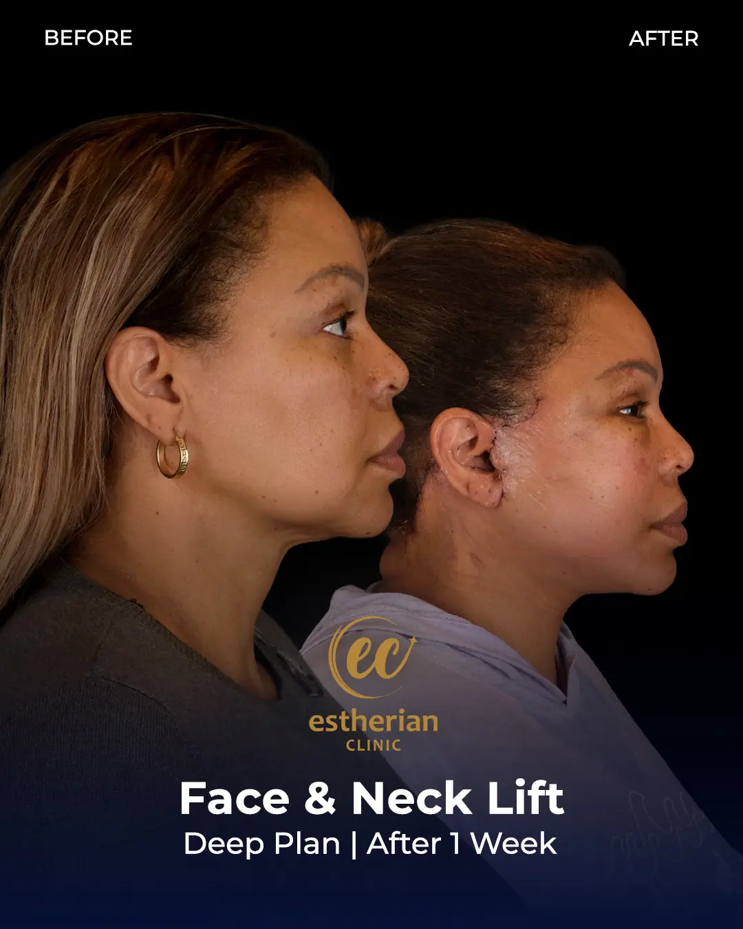 Face and Neck Lift Before and After Gallery by the Estherian Clinic