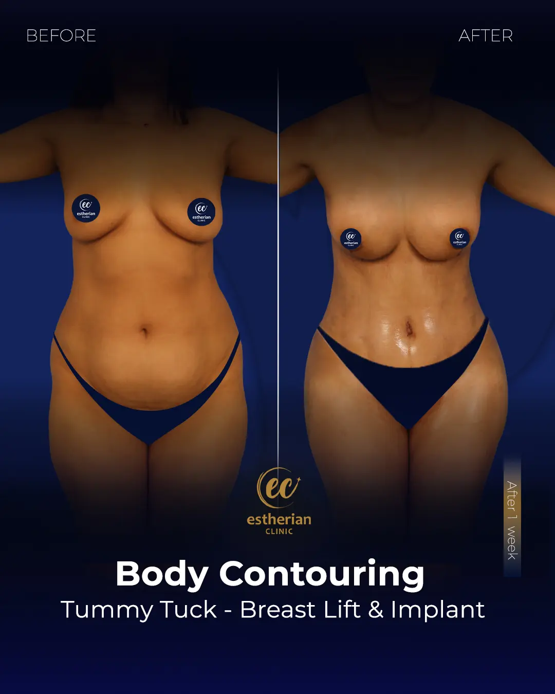 Body Contouring Surgery (before and after) by the Estherian Clinic