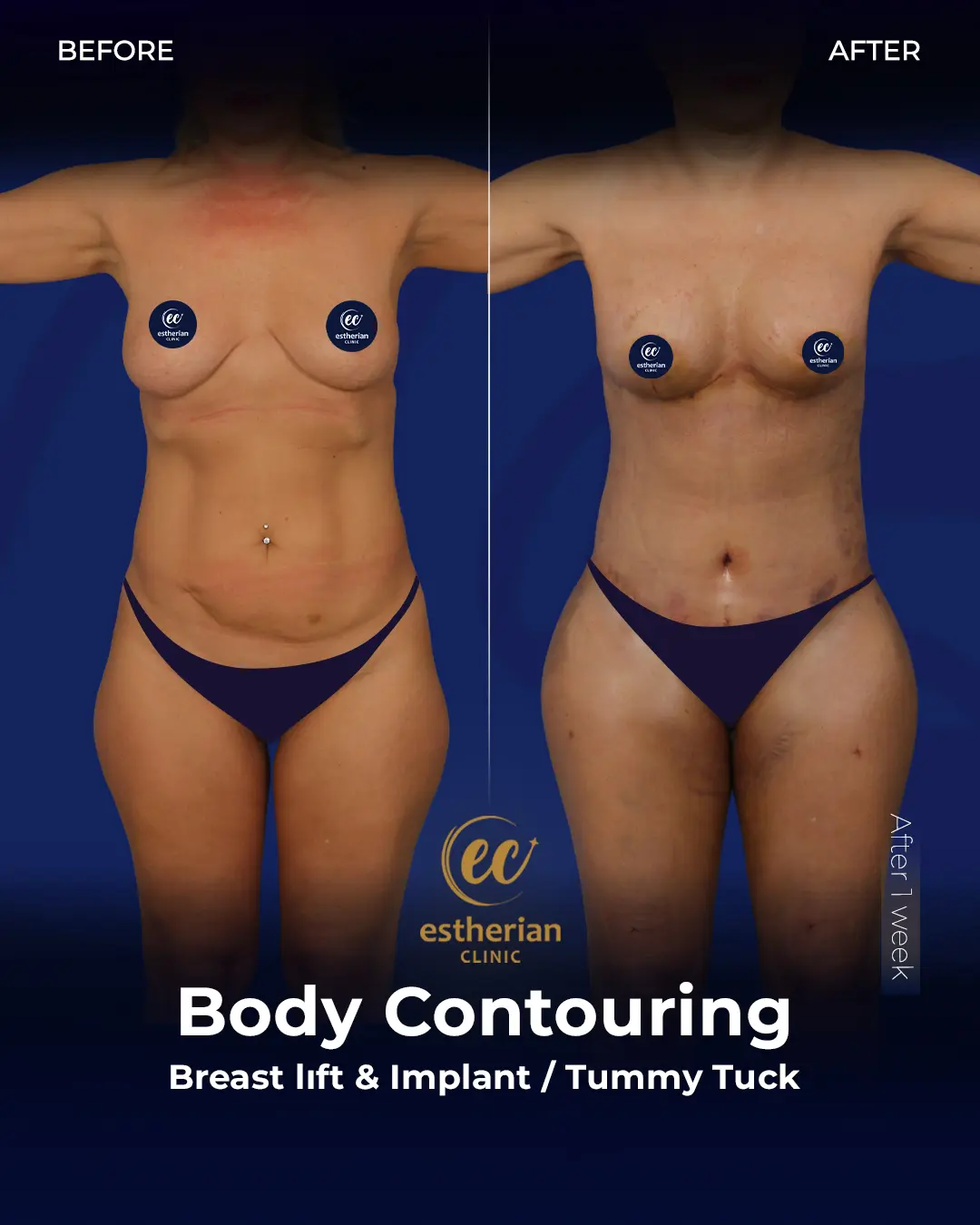 Body Contouring Surgery (before and after) by the Estherian Clinic