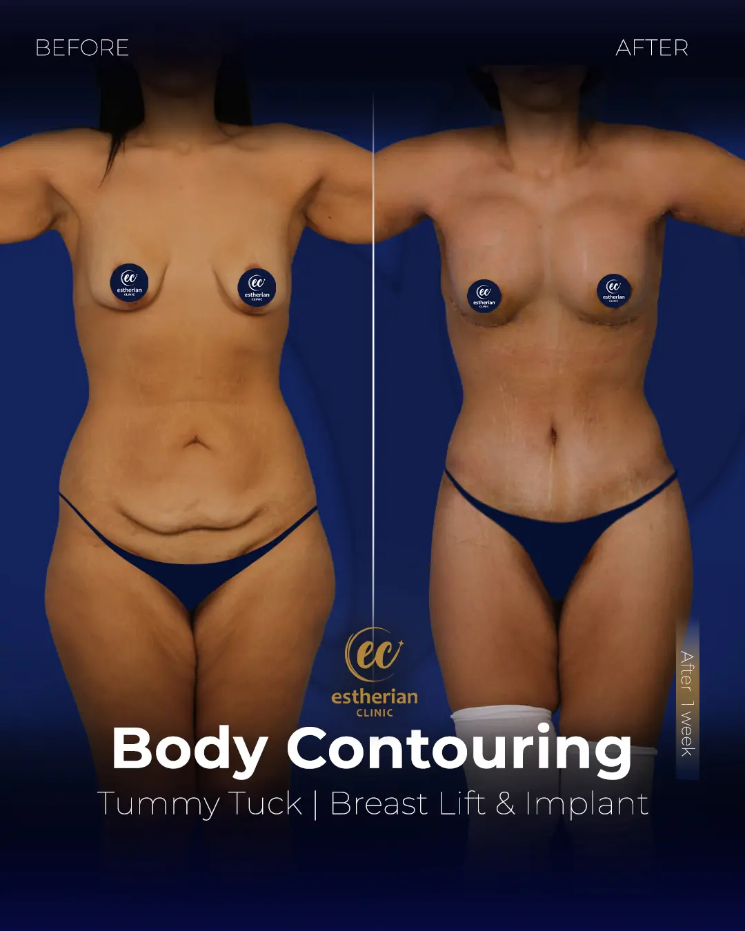 Body Contouring Surgery (before and after) by the Estherian Clinic