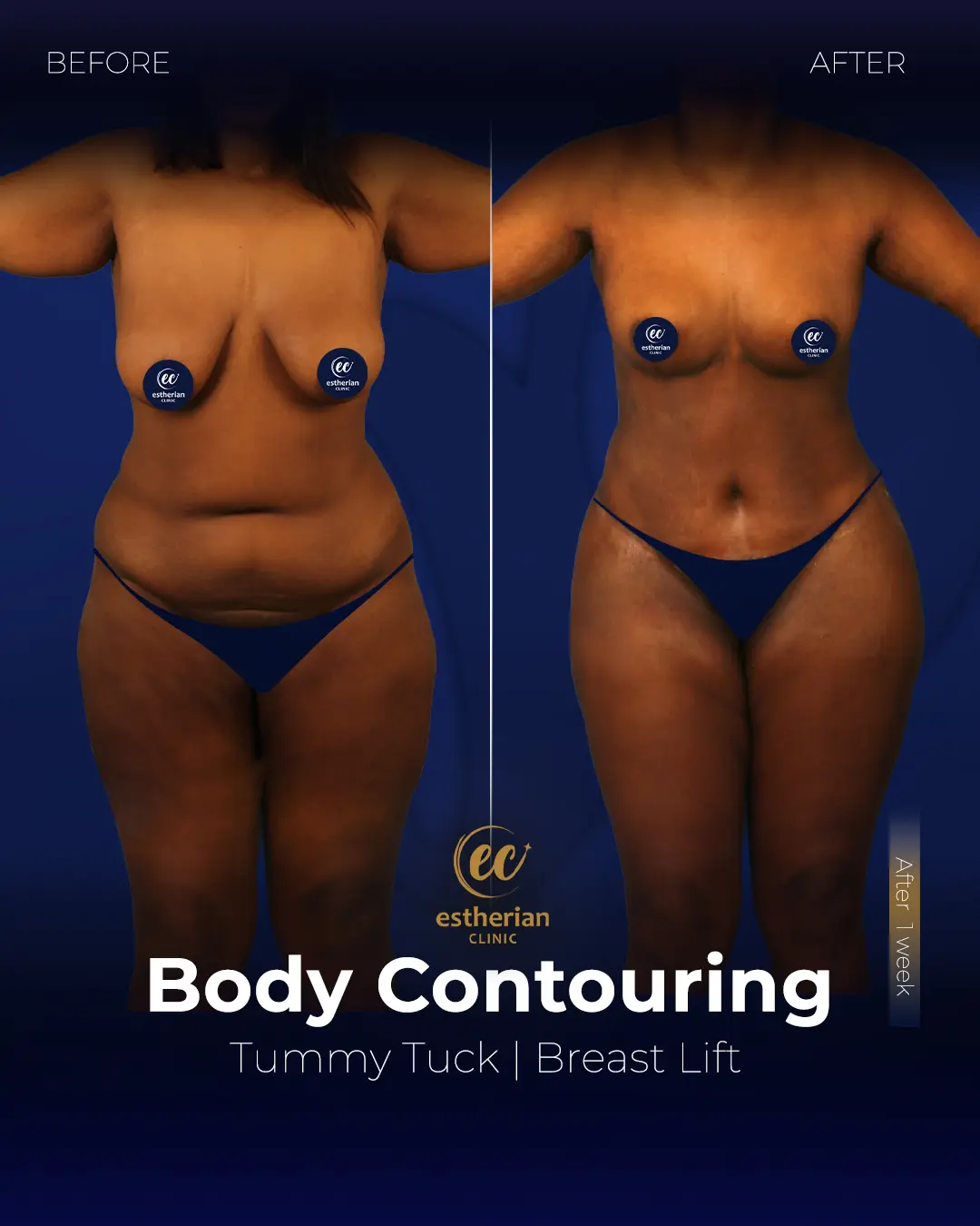 Body Contouring Surgery (before and after) by the Estherian Clinic