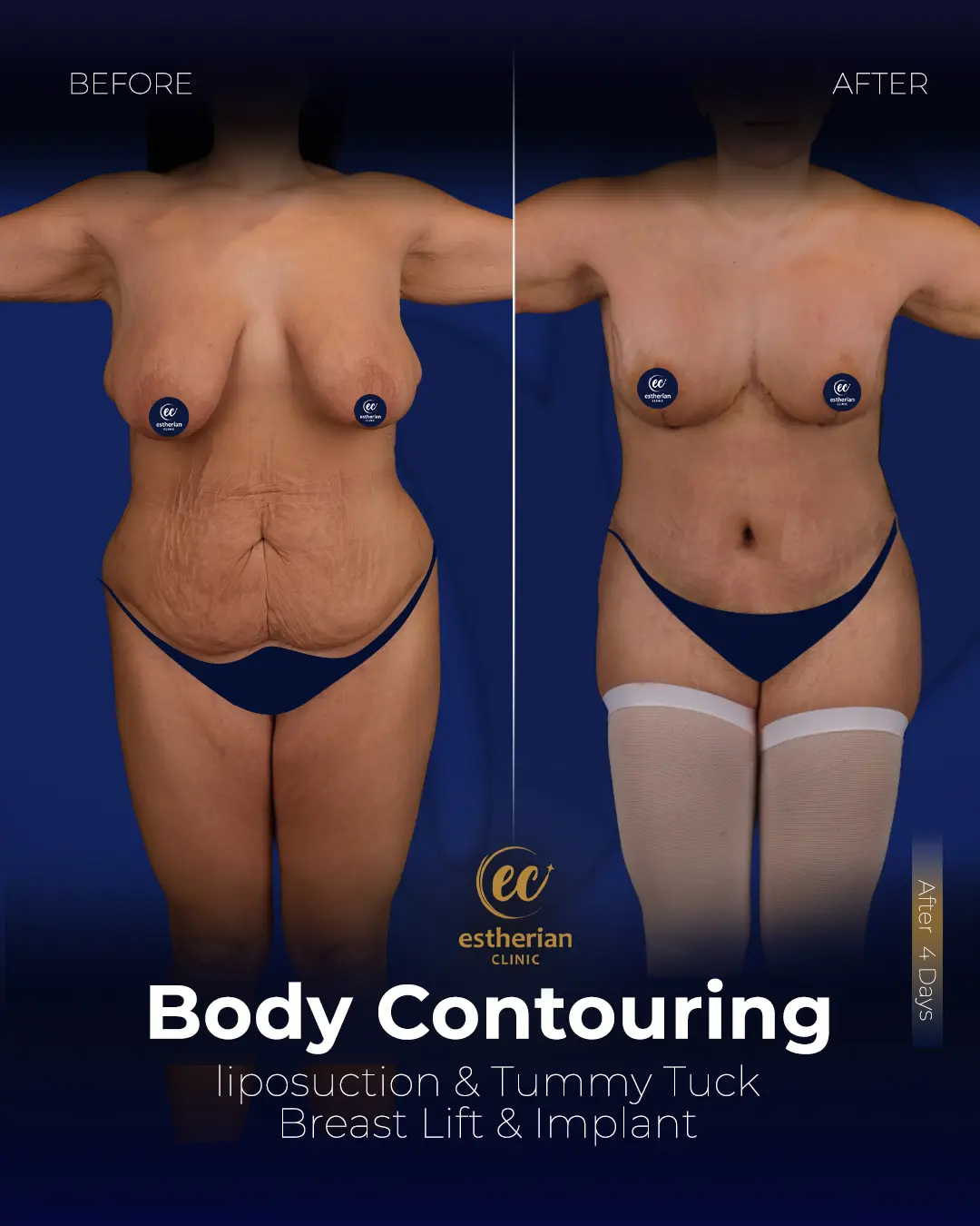 Body Contouring Surgery (before and after) by the Estherian Clinic
