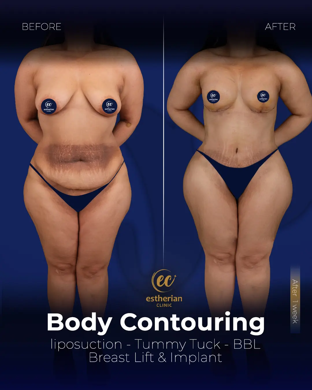 Body Contouring Surgery (before and after) by the Estherian Clinic