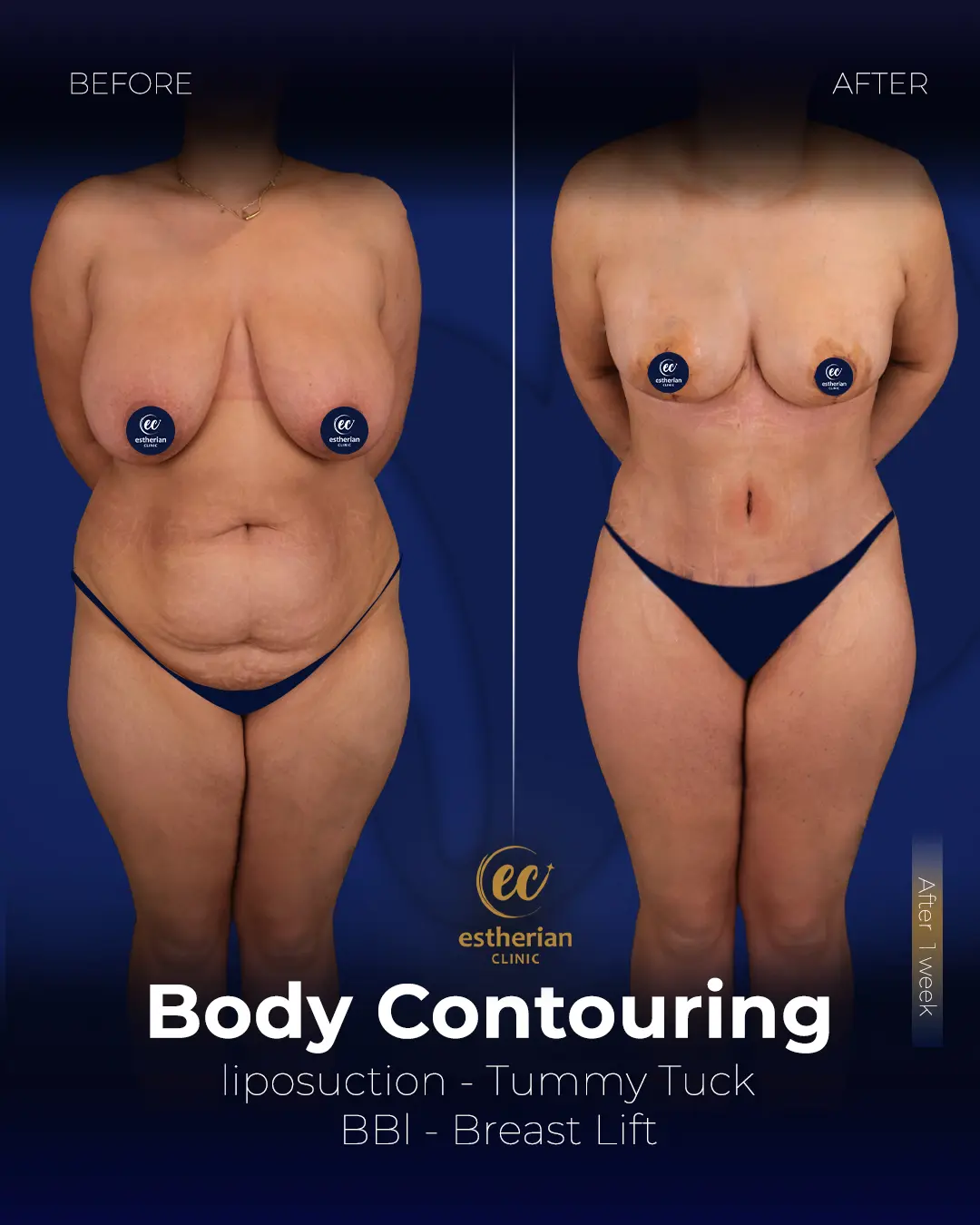 Body Contouring Surgery (before and after) by the Estherian Clinic