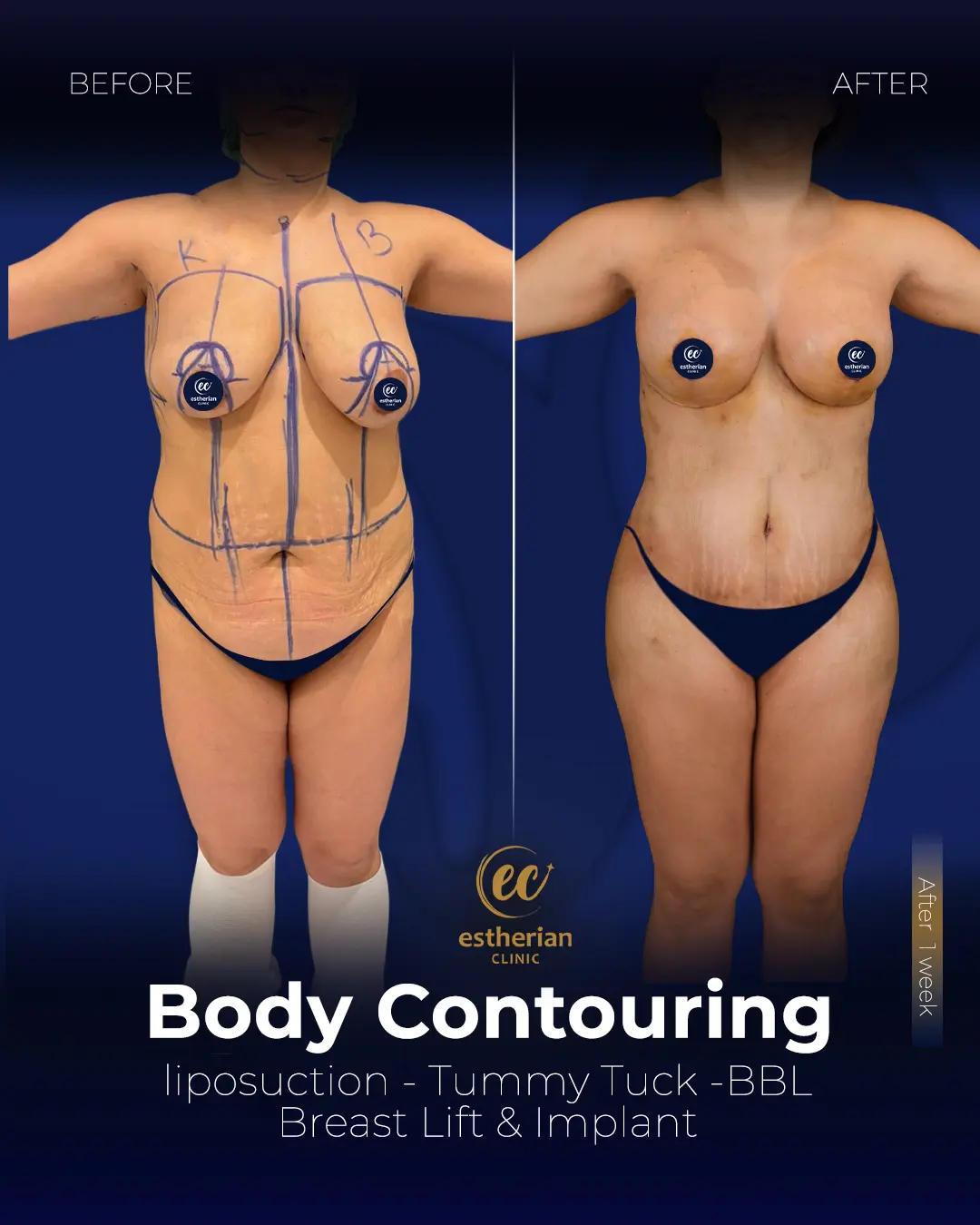 Body Contouring Surgery (before and after) by the Estherian Clinic