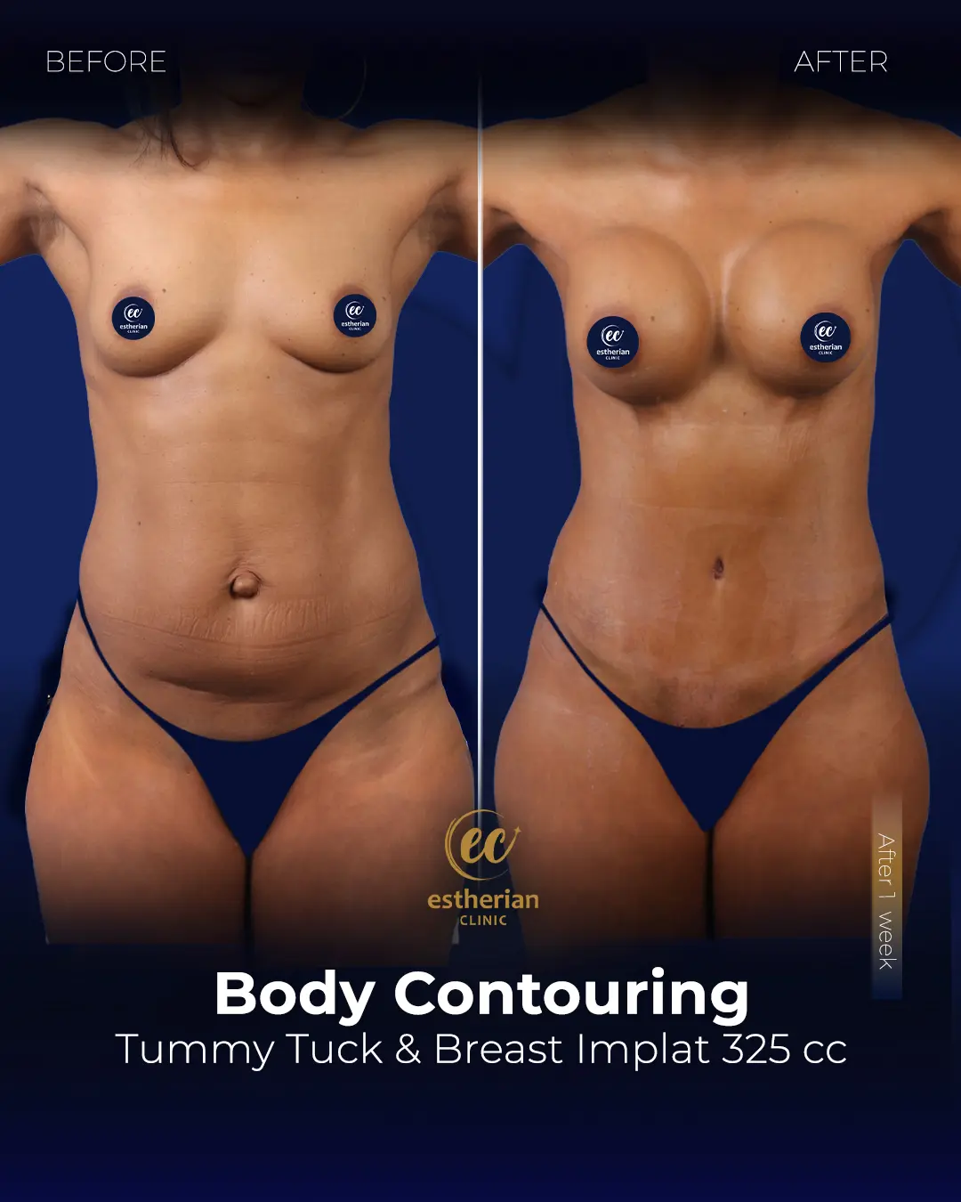 Body Contouring Surgery (before and after) by the Estherian Clinic