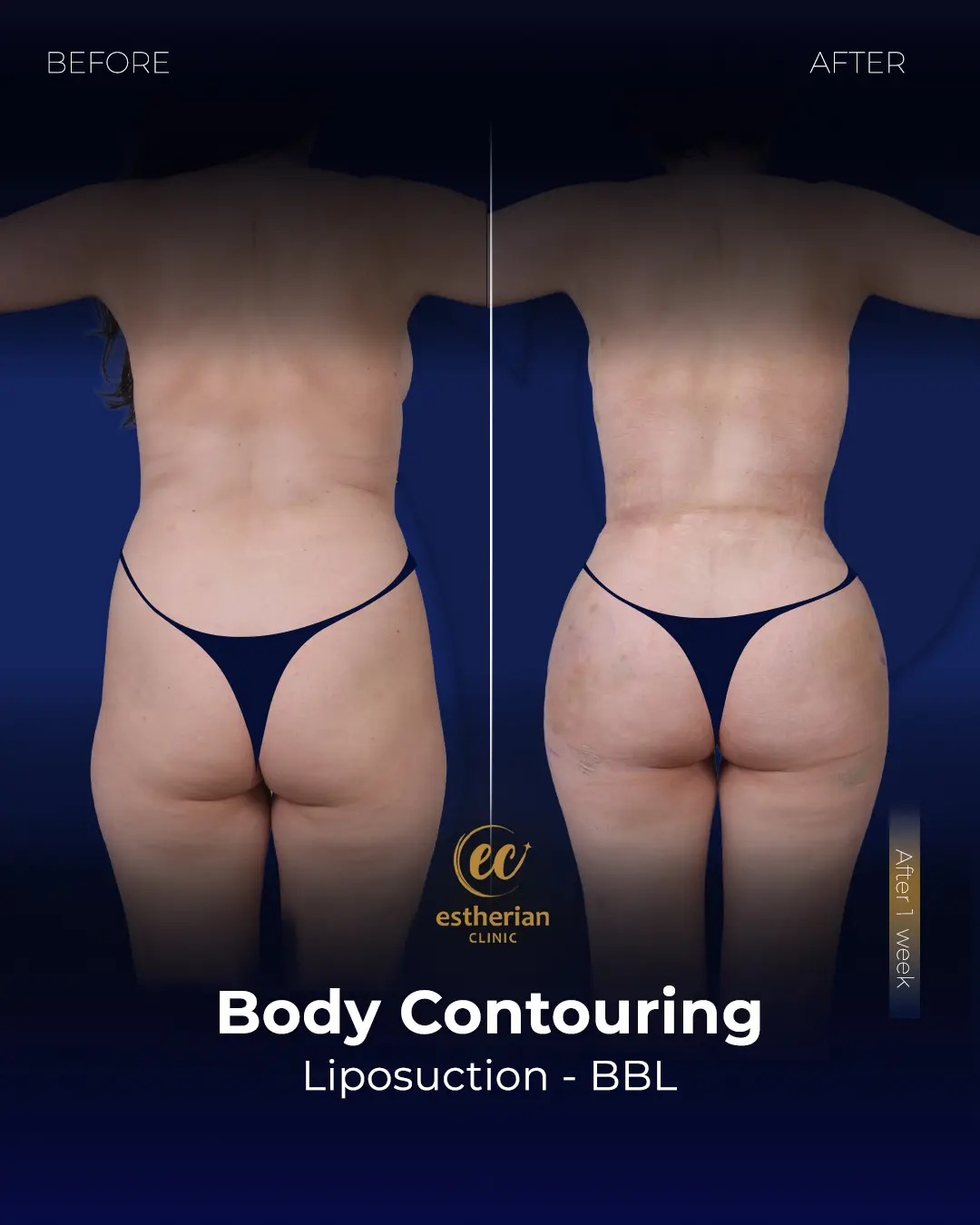 Body Contouring Surgery (before and after) by the Estherian Clinic