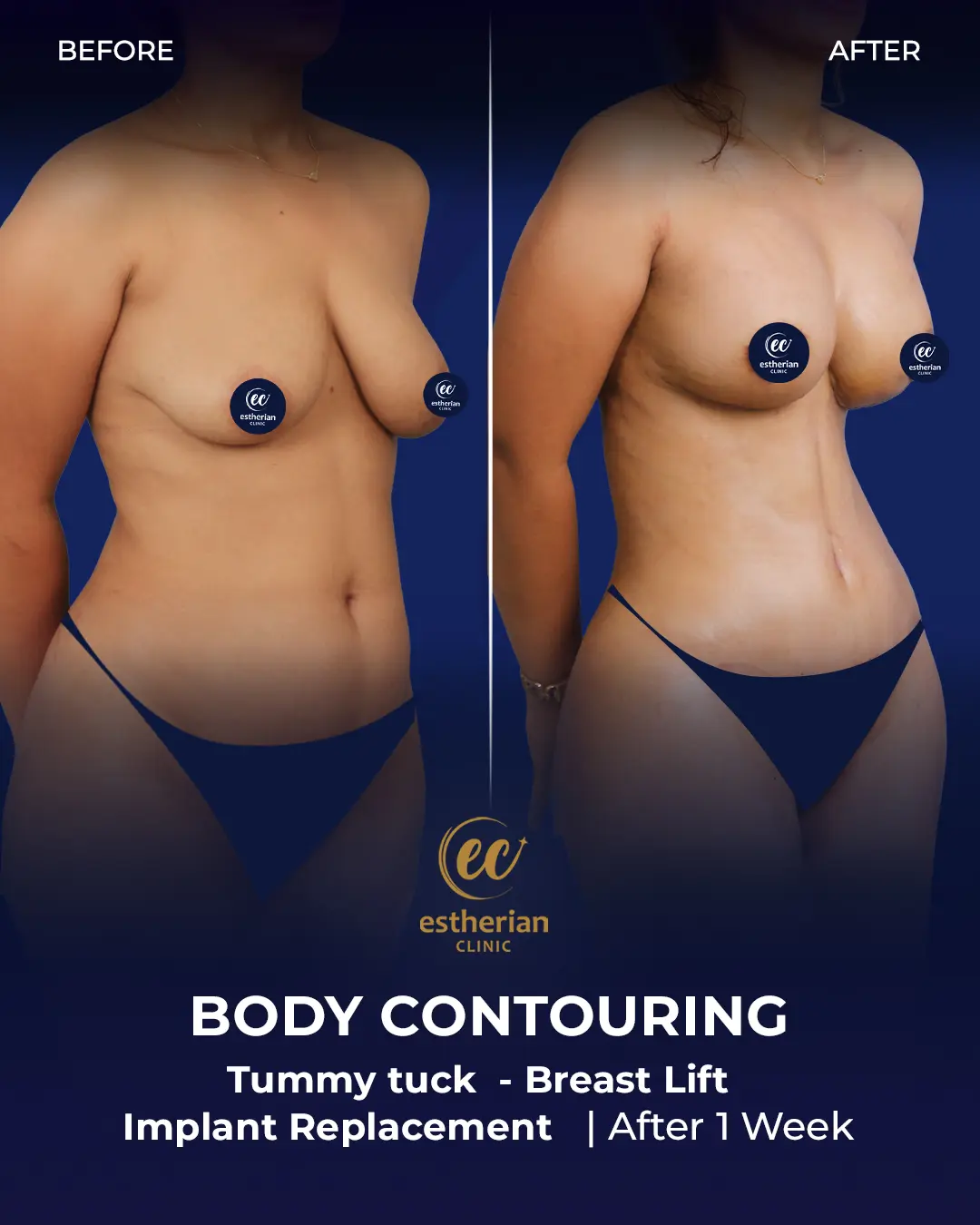 Body Contouring Surgery (before and after) by the Estherian Clinic