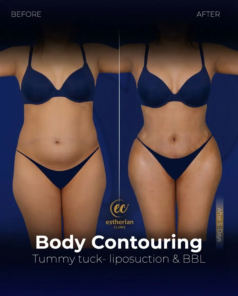Body Contouring Surgery (before and after) by the Estherian Clinic