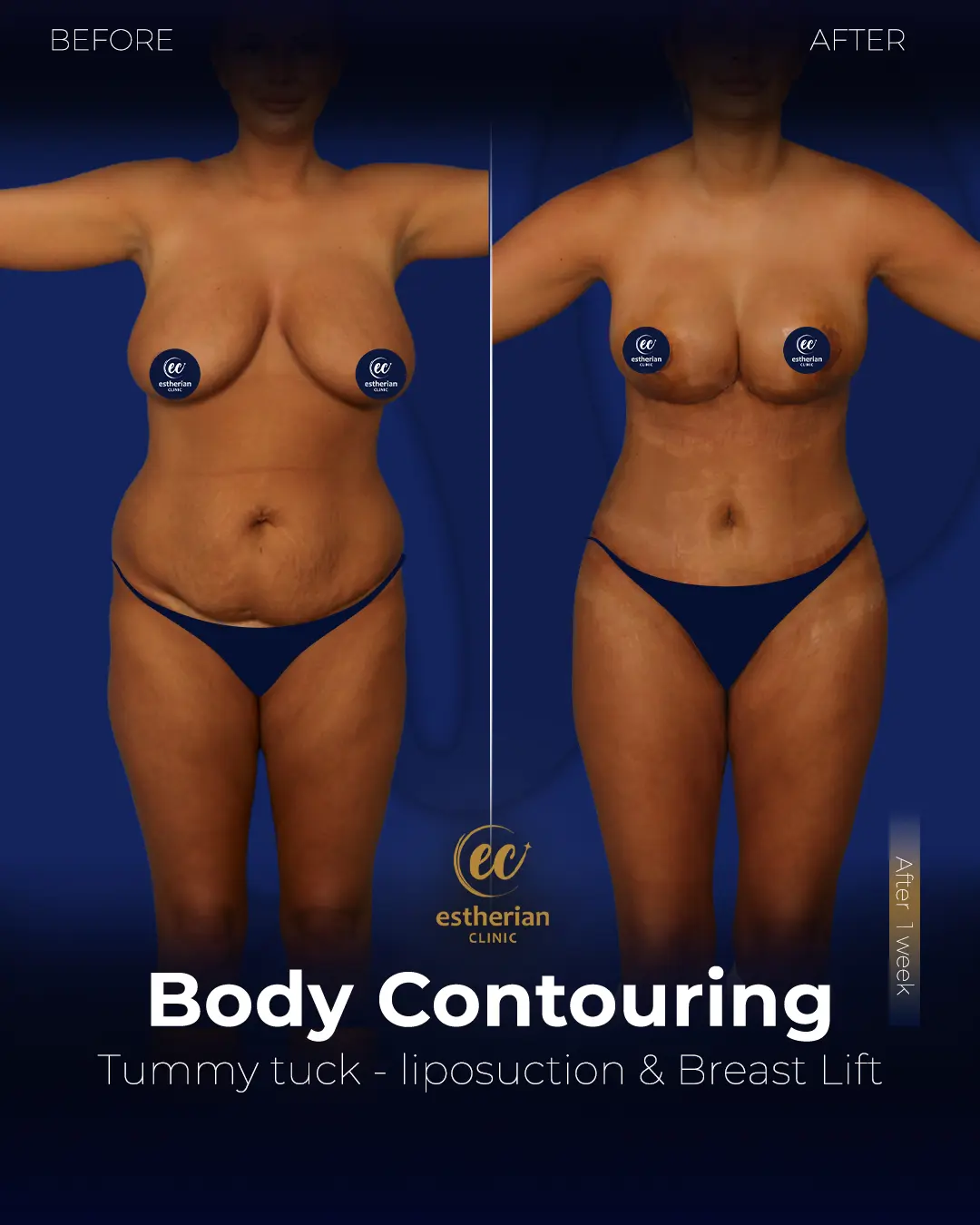 Body Contouring Surgery (before and after) by the Estherian Clinic
