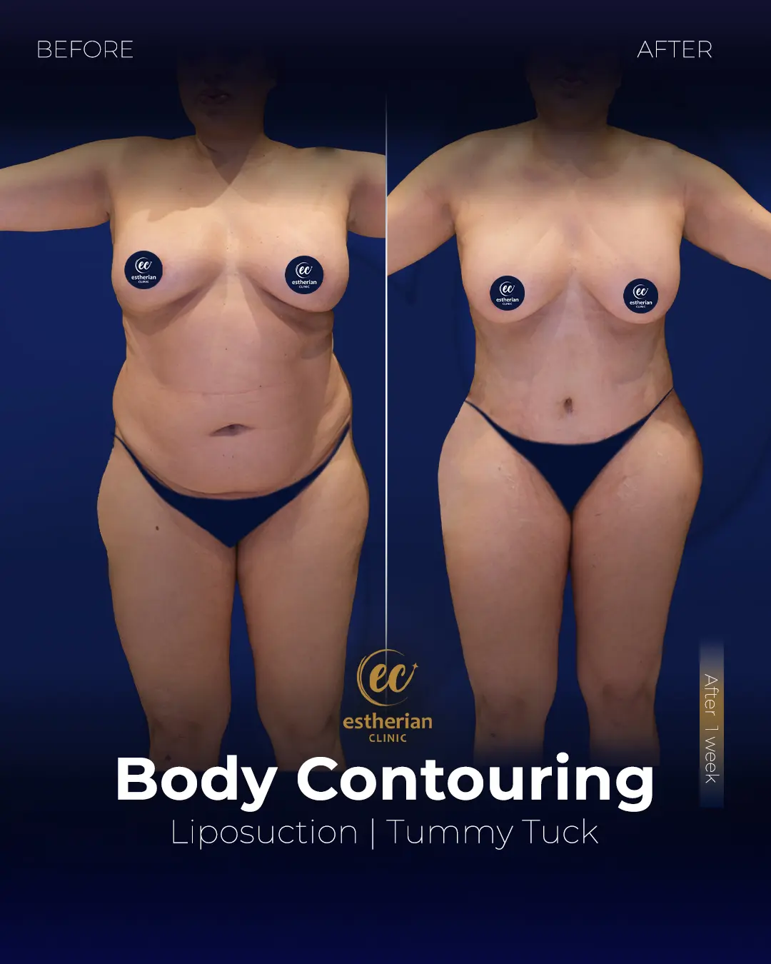 Body Contouring Surgery (before and after) by the Estherian Clinic