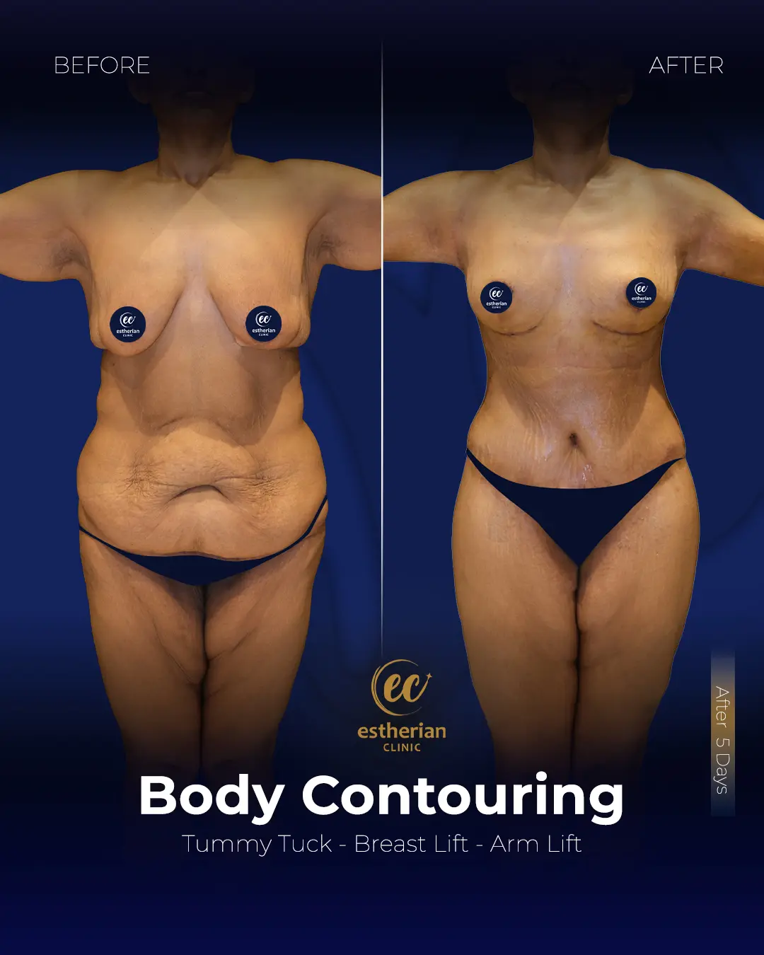 Body Contouring Surgery (before and after) by the Estherian Clinic
