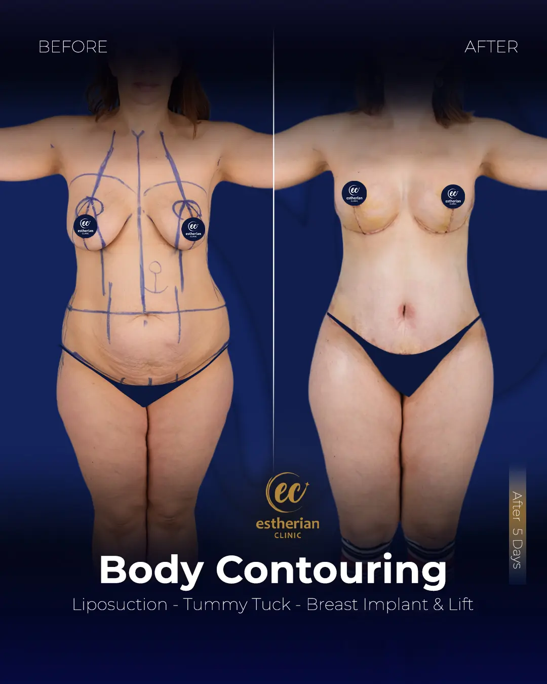 Body Contouring Surgery (before and after) by the Estherian Clinic