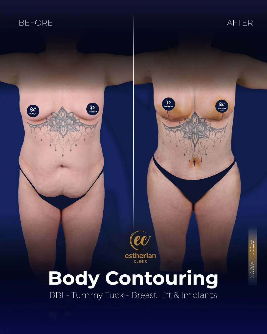 Body Contouring Surgery (before and after) by the Estherian Clinic