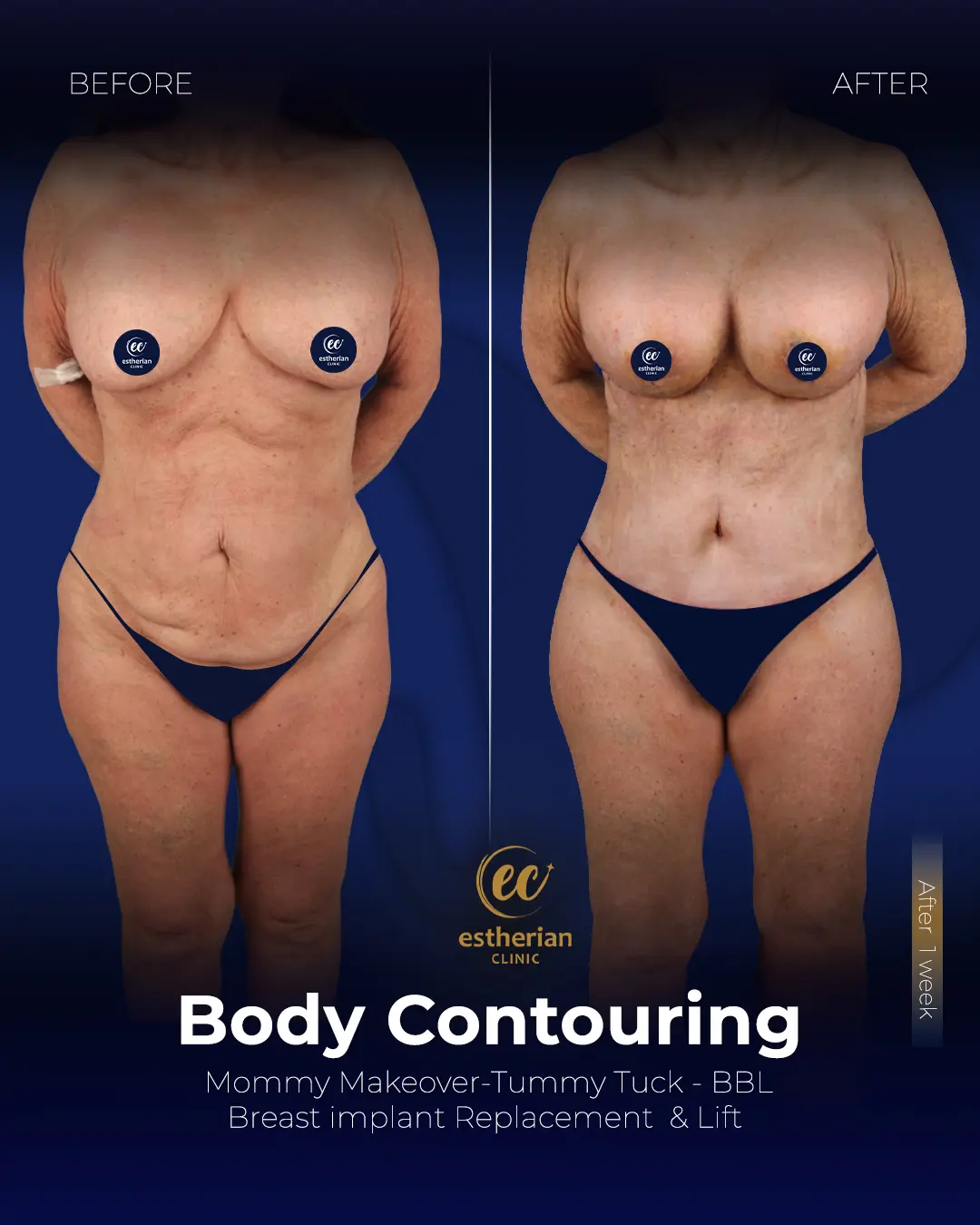 Body Contouring Surgery (before and after) by the Estherian Clinic