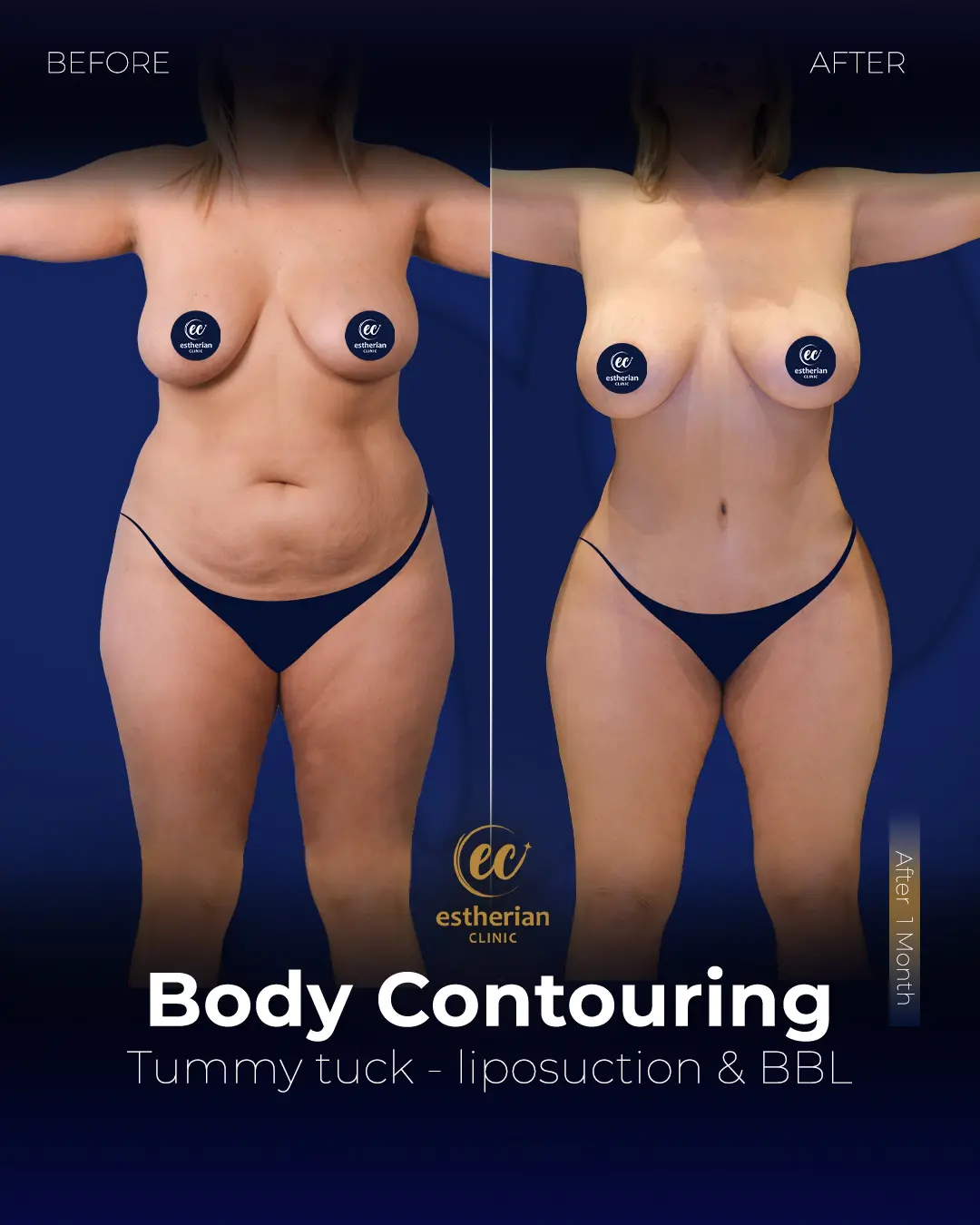 Body Contouring Surgery (before and after) by the Estherian Clinic