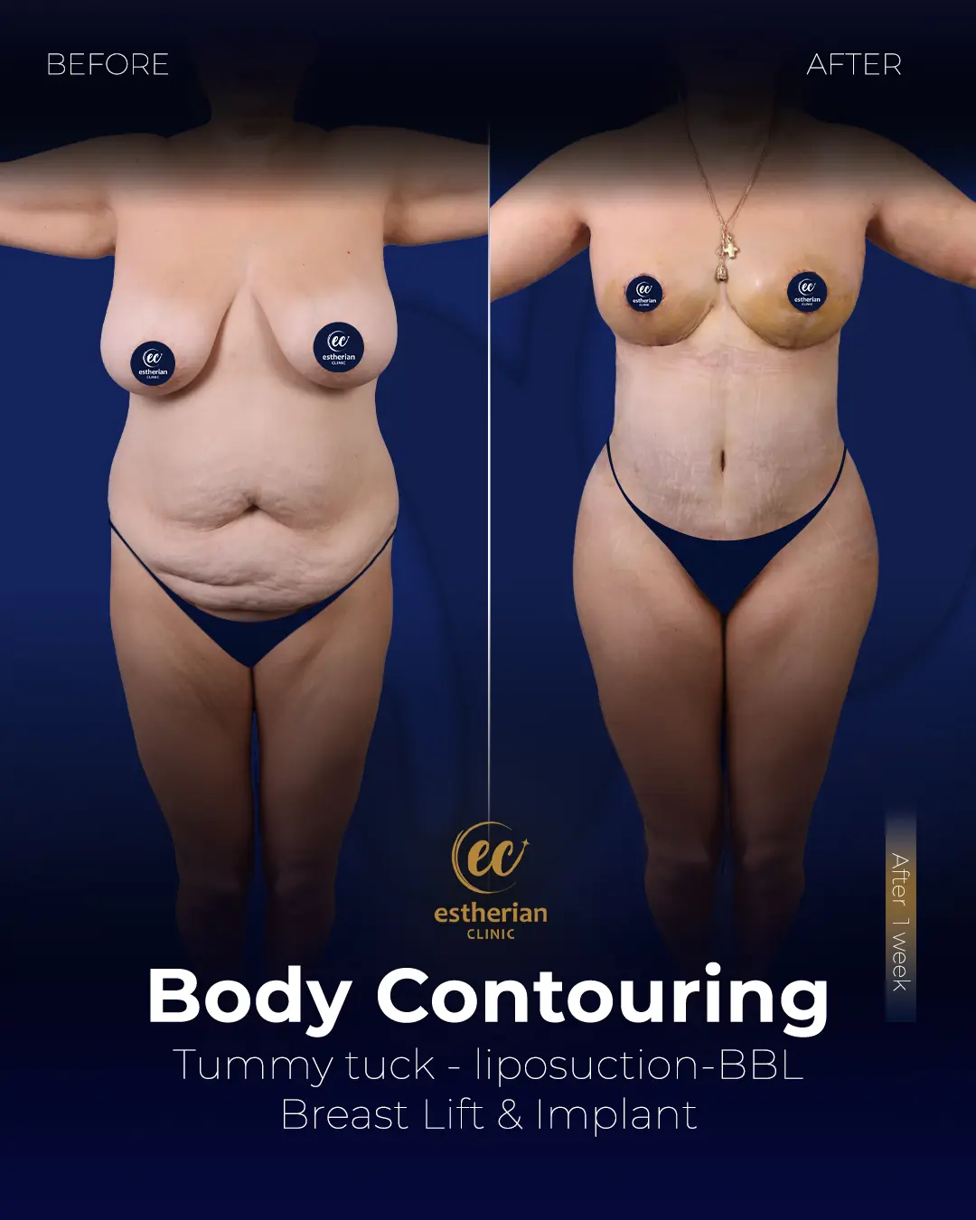 Body Contouring Surgery (before and after) by the Estherian Clinic