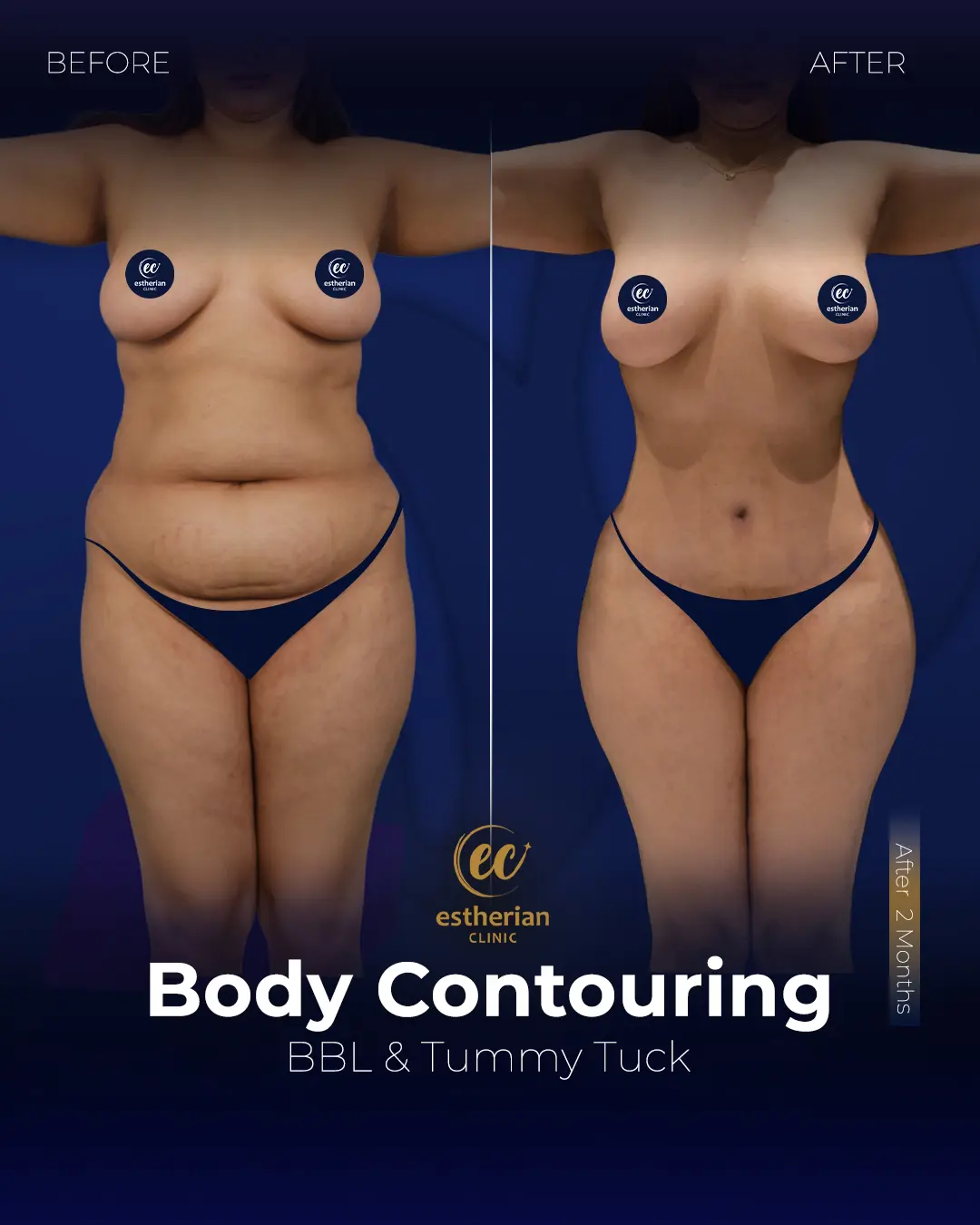 Body Contouring Surgery (before and after) by the Estherian Clinic